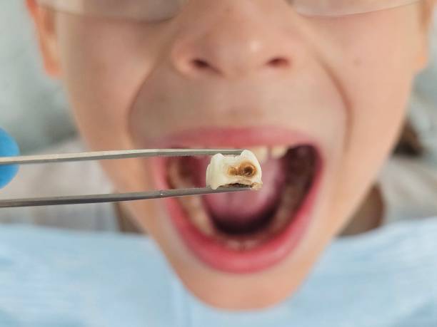 Best Emergency Dental Care for Sports Injuries in St Joseph, MO